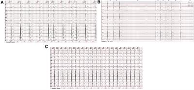 Cardioneuroablation for successful treatment of symptomatic bradycardia in a 12-year-old child after a 6-month follow-up